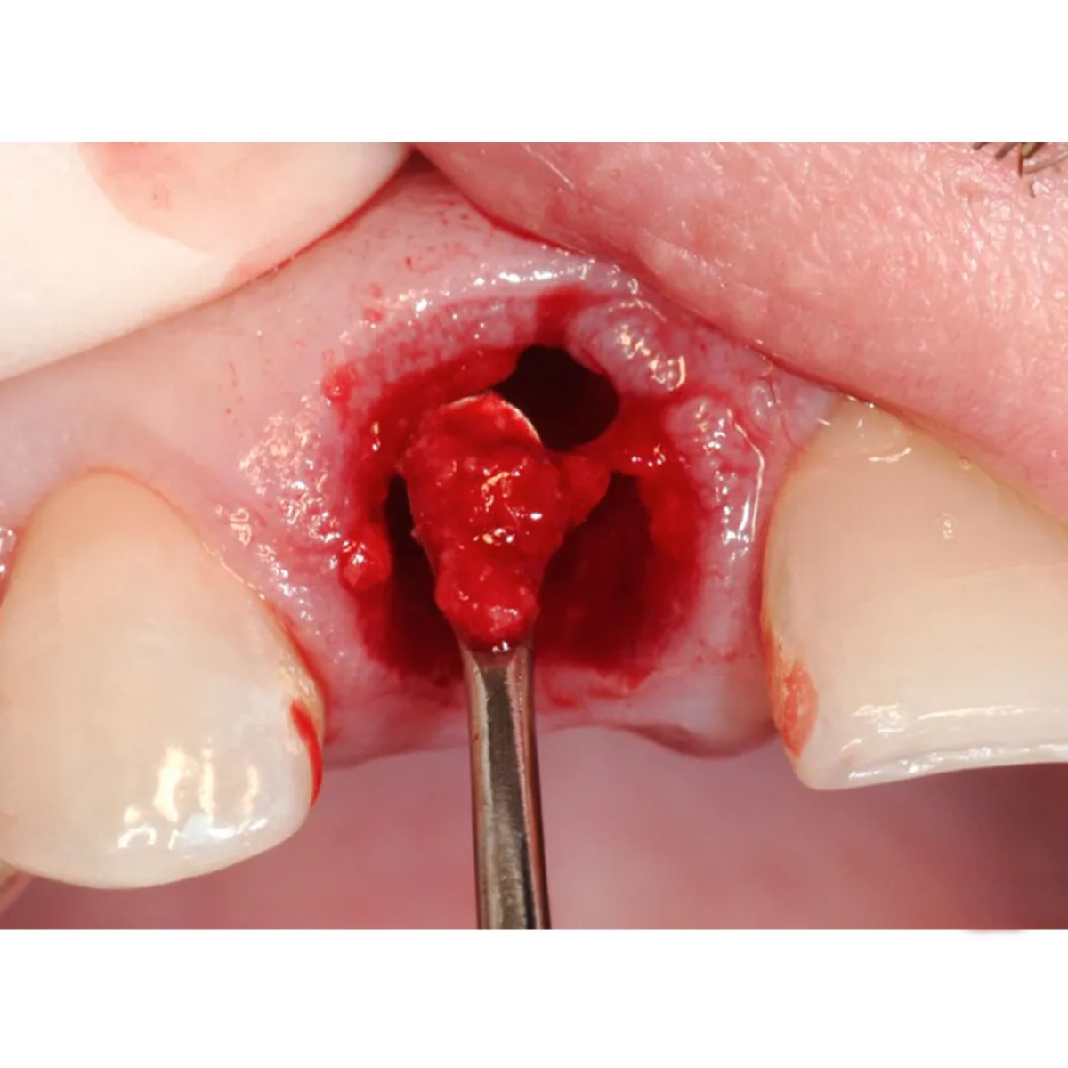 GDC Lucas Surgical Curette # 3 (CL84 # 3)