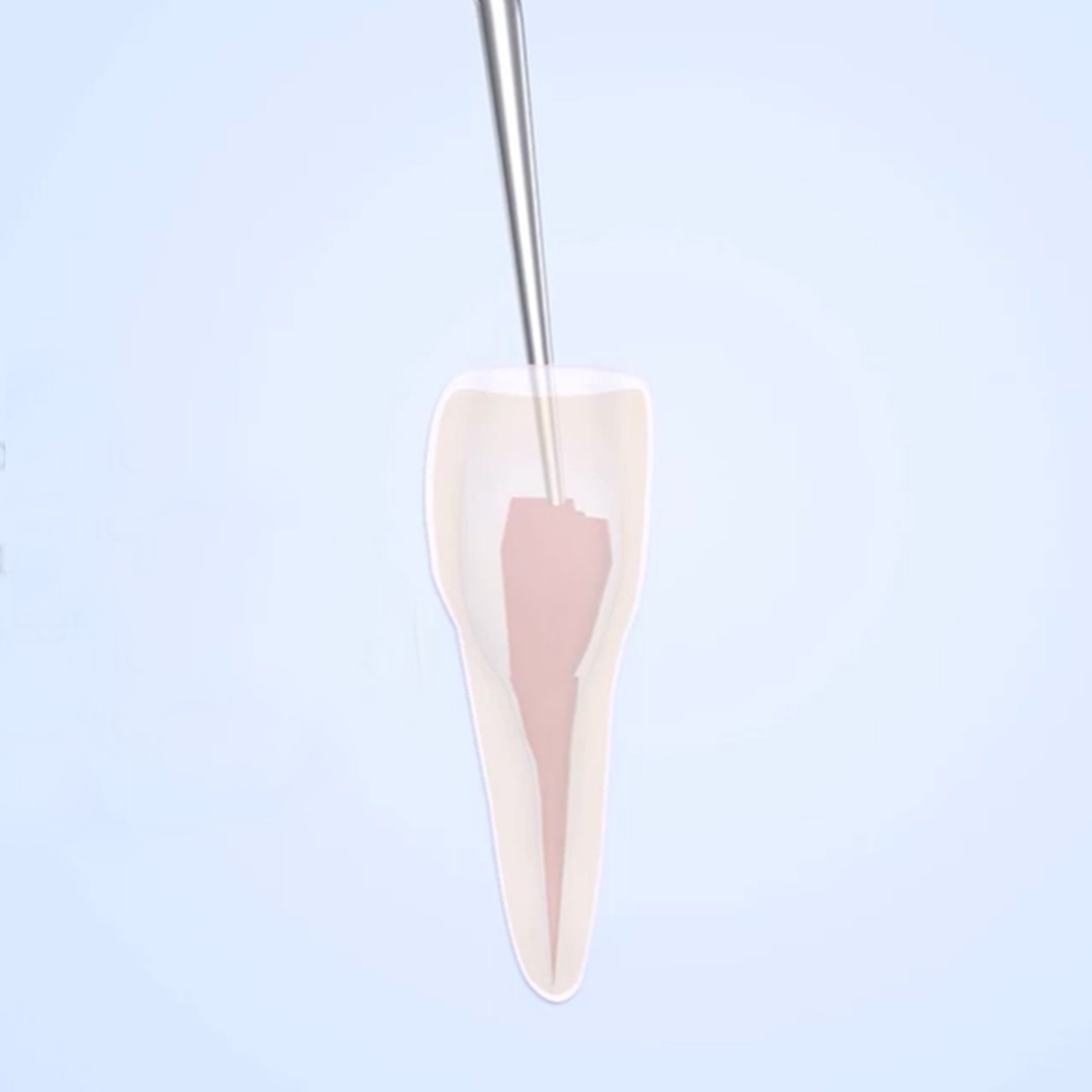 Woodpecker Scaler Tip ED3 for DTE & Satelec Scalers