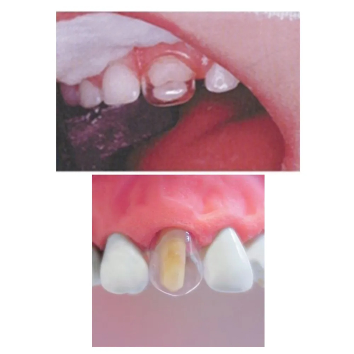 Tor Vm Transparent Crowns 40 pcs - Premolar No. 1.911P