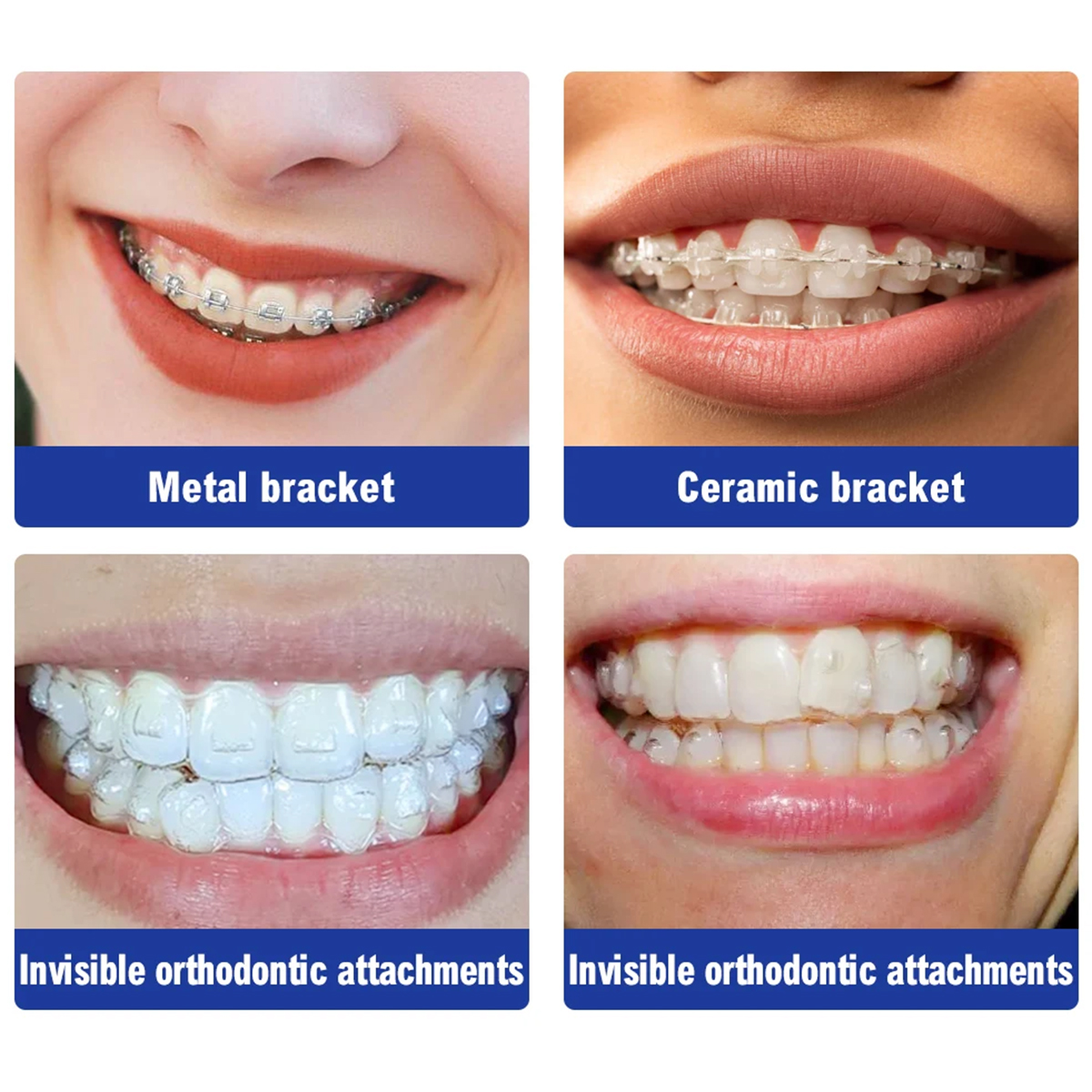 Prime Dental Restorite OrthoGrip Light Cure Orthodontic Adhesive Kit