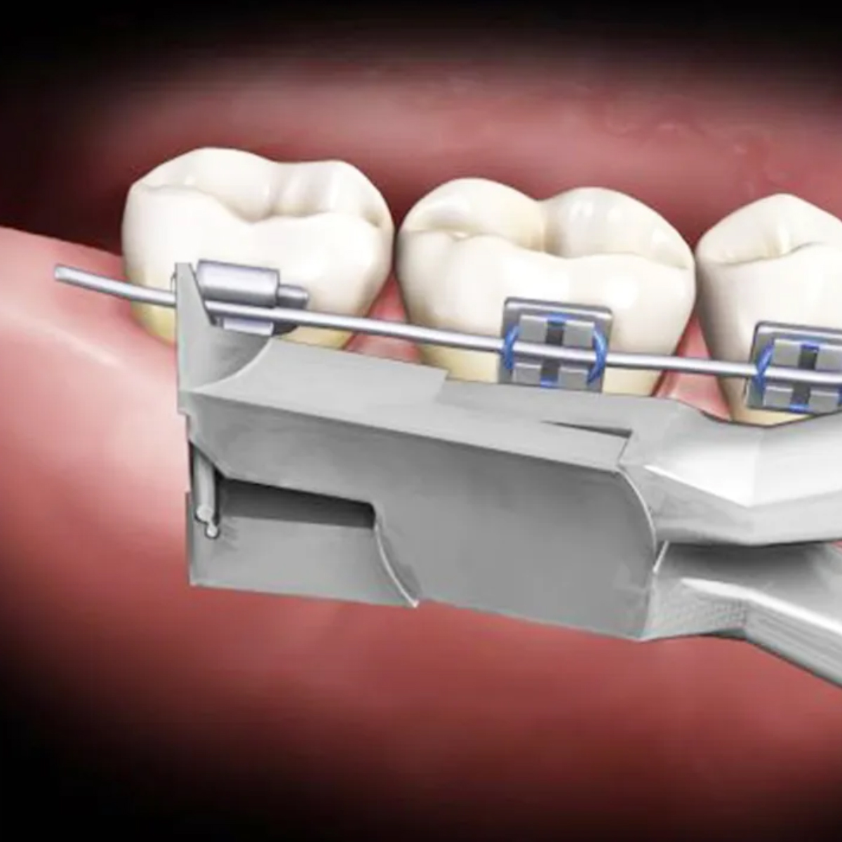 GDC Orthodontics Cutter Tc Distal End Cutter - Short Handle (3000/67S)