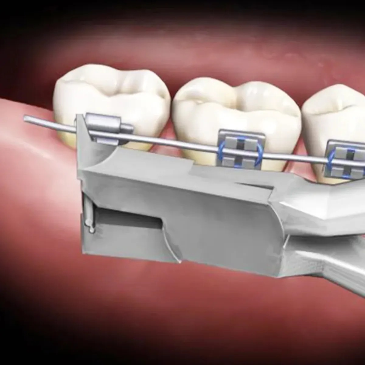 OSL Distal End Cutters