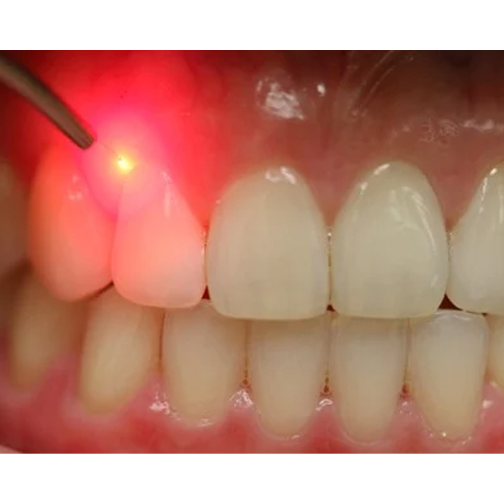 Woodpecker LX16 Diode Laser Handpiece With Cable