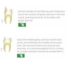 Woodpecker Fi-G Obturation Gun Tips - 14