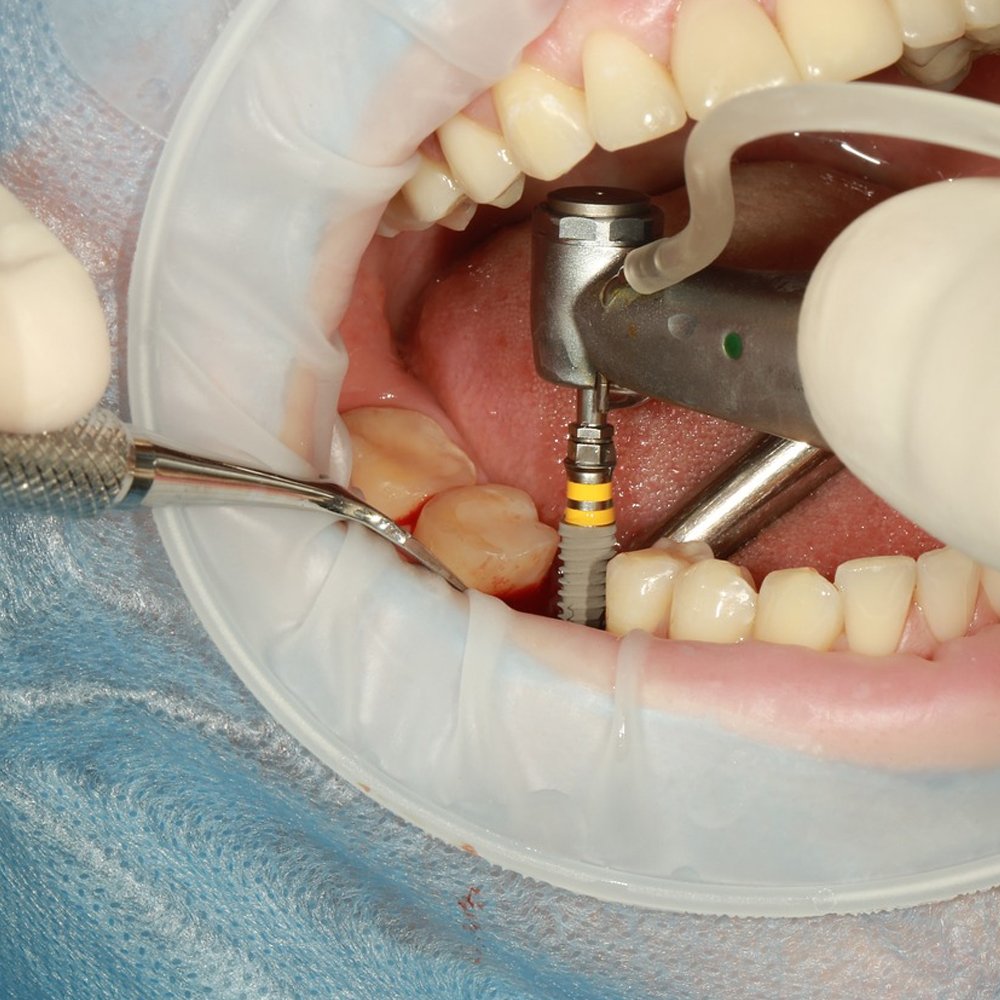 Woodpecker LED Implant Contra Angle Handpiece - WP-1L