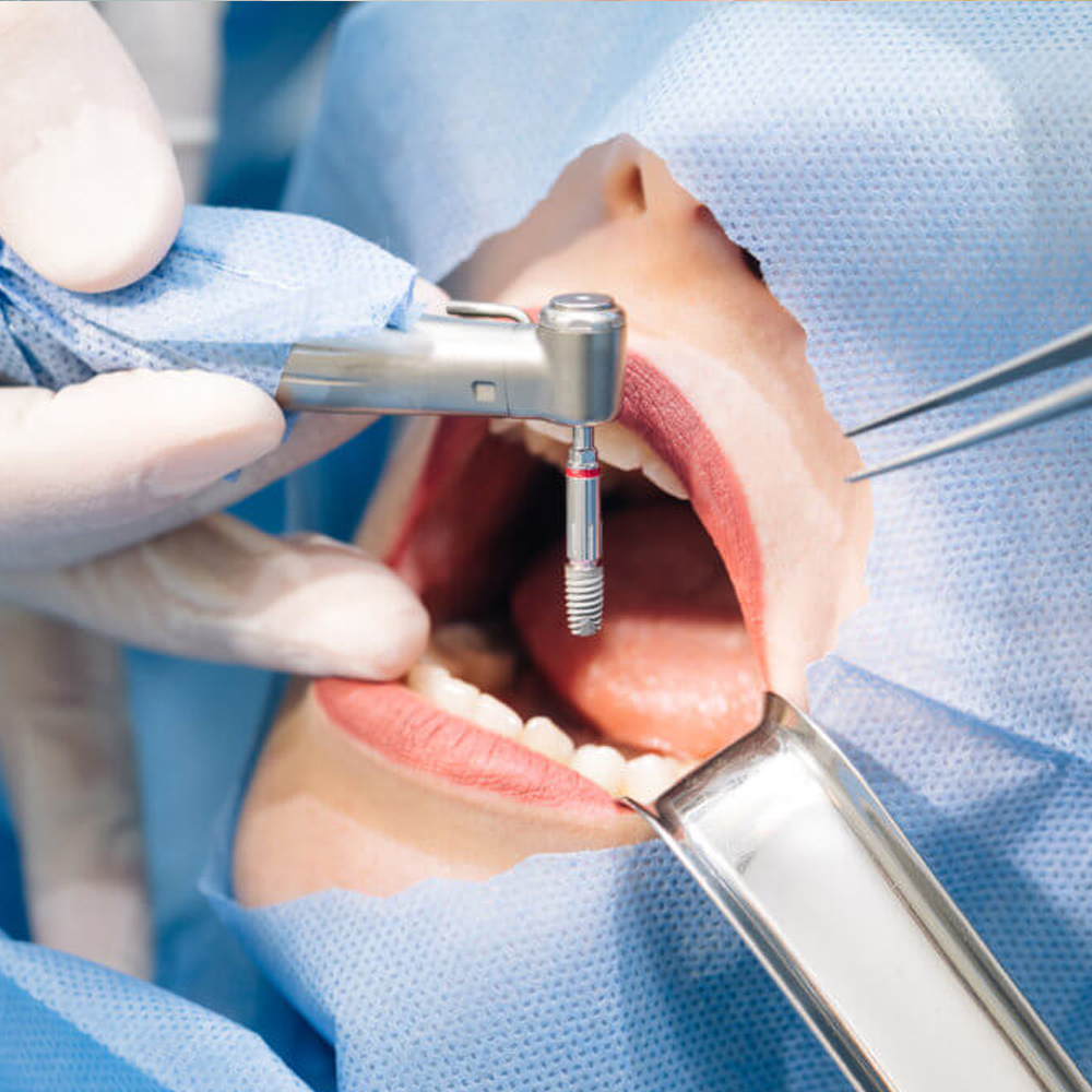 Woodpecker LED Implant Contra Angle Handpiece - WP-1L