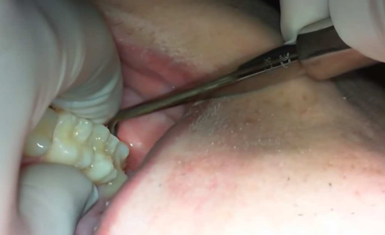 Waldent Root Elevators Warwick James Set of 3 (K2/3)