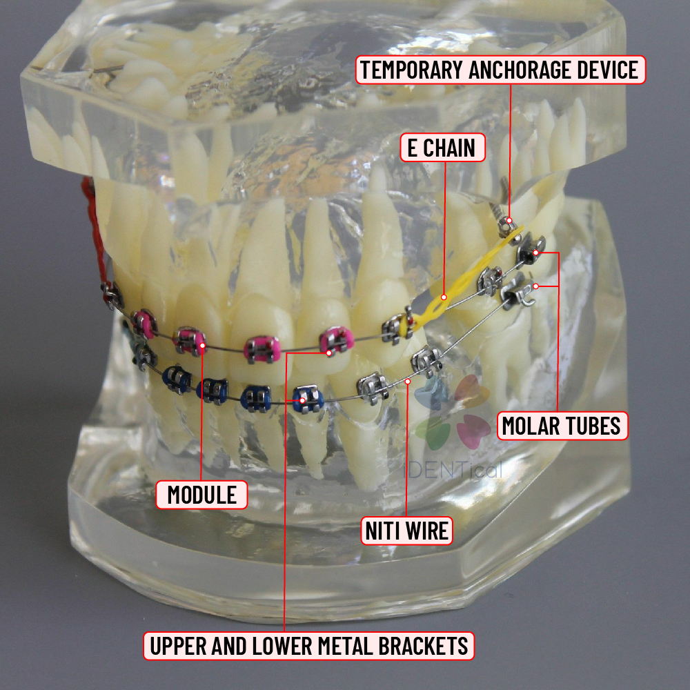 iDENTical Dental Orthodontic Models M3005