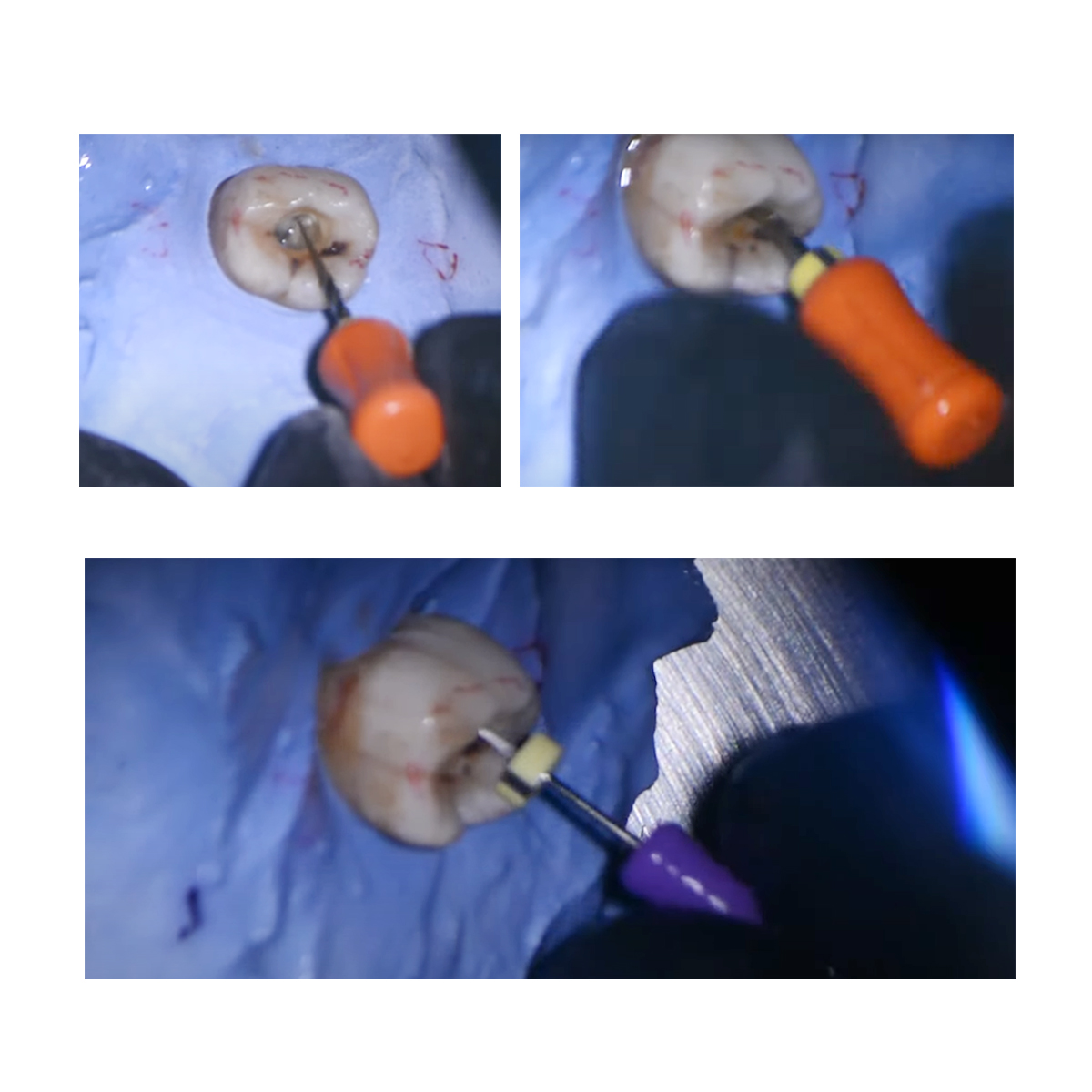 Waldent Pro-Taper Gold Hand File 21mm Assorted SX-F3 