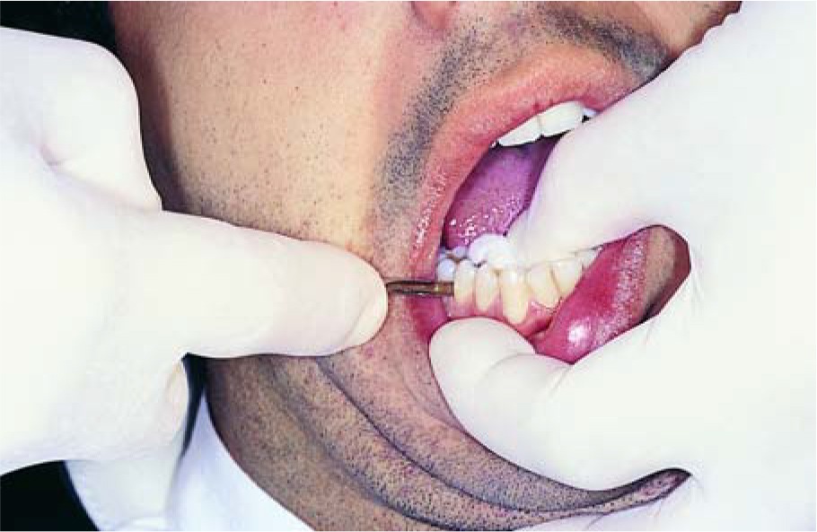 Waldent Root Elevator Instruments Kit Set of 11 K2/4