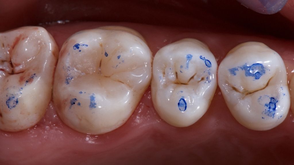 Maarc Dental Articulating Paper - 40µ Microns & 100µ Microns