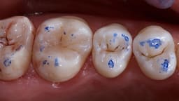 Maarc Dental Articulating Paper - 40µ Microns & 100µ Microns - 4