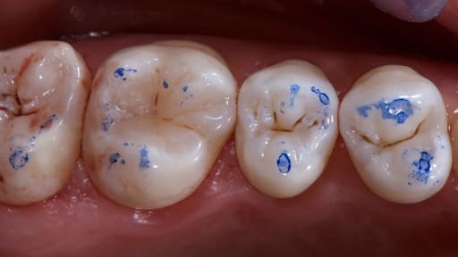 Maarc Dental Articulating Paper - 40µ Microns & 100µ Microns