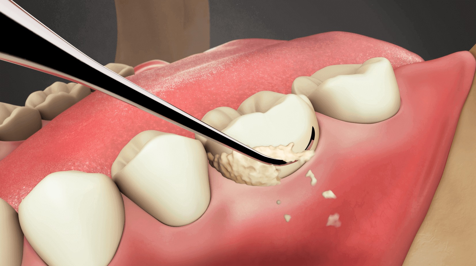 API Manipal Scalers Set of 3