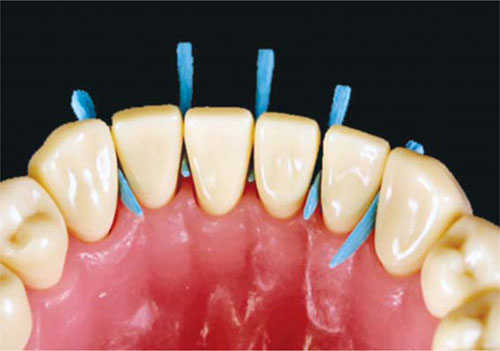 Cotisen Wooden Wedges