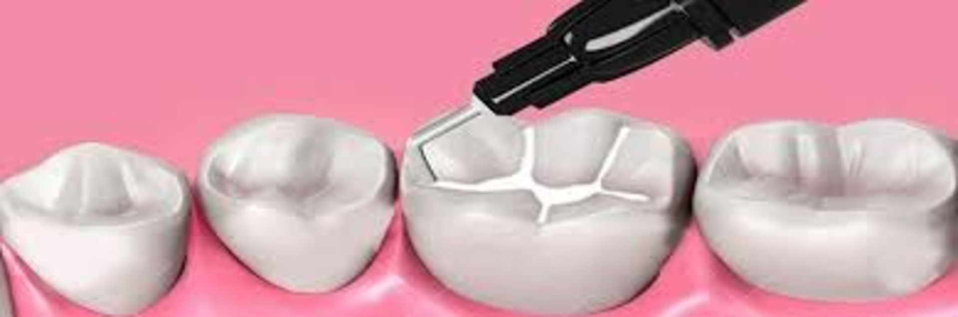 Sdi Wave Flowable Composite A1