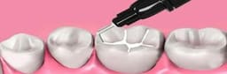Ivoclar Tetric N-Flow Bulk Fill Composite IVA - 5