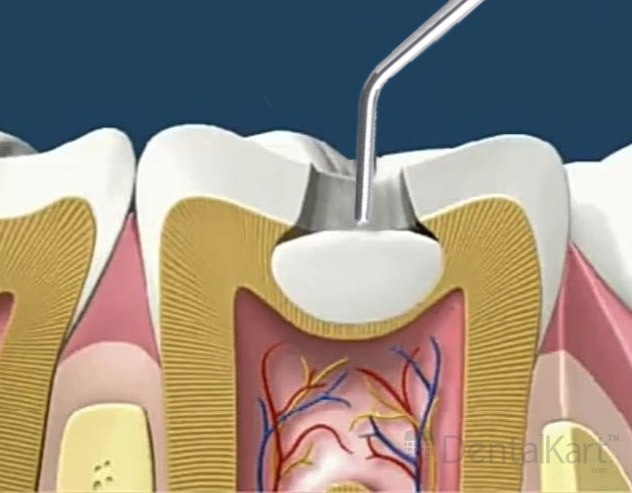 Waldent Plastic Filling Instrument Ball Burnisher + Condenser 15/732
