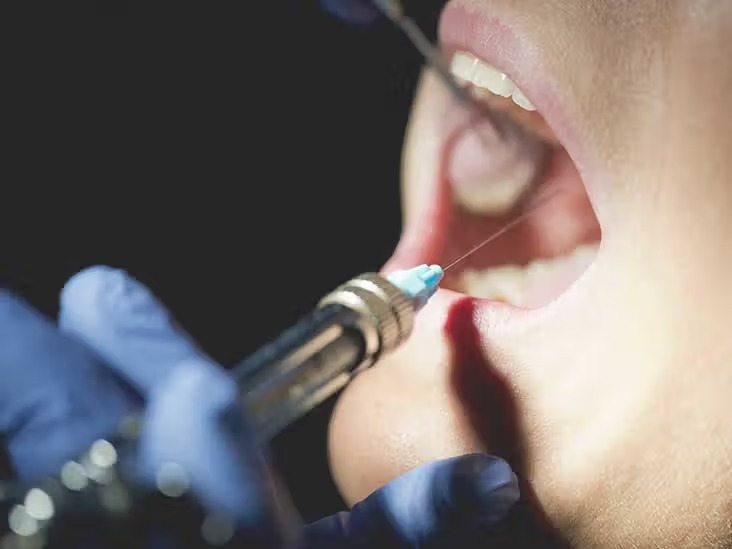 Vishal DentoCare Ligno Prick Cartridges (Pack of 50) 