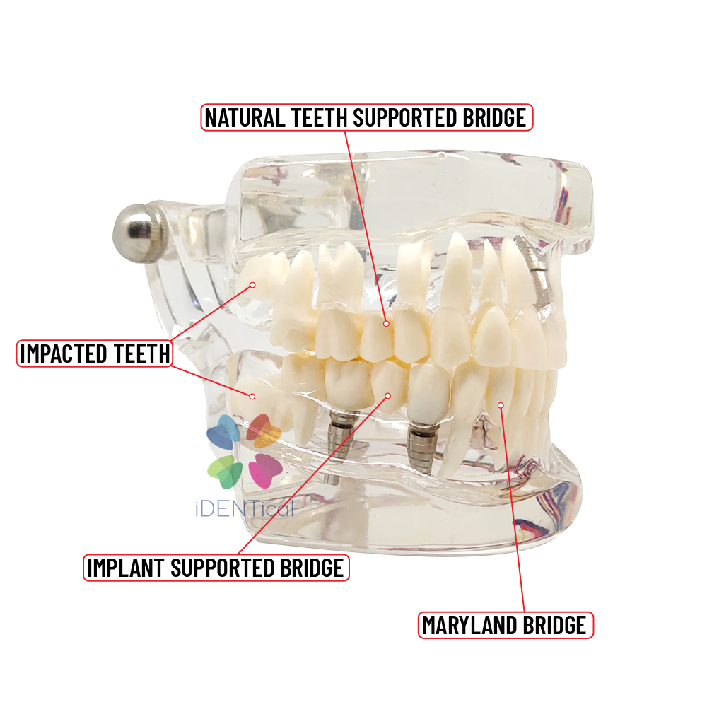 iDENTical Patient Education Model (Caries,implant,Nerves) M2001-3