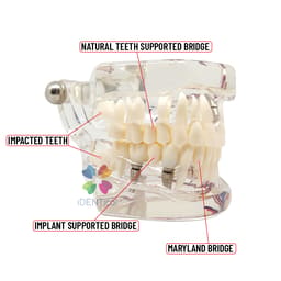 iDENTical Patient Education Model (Caries,implant,Nerves) M2001-3 - 7