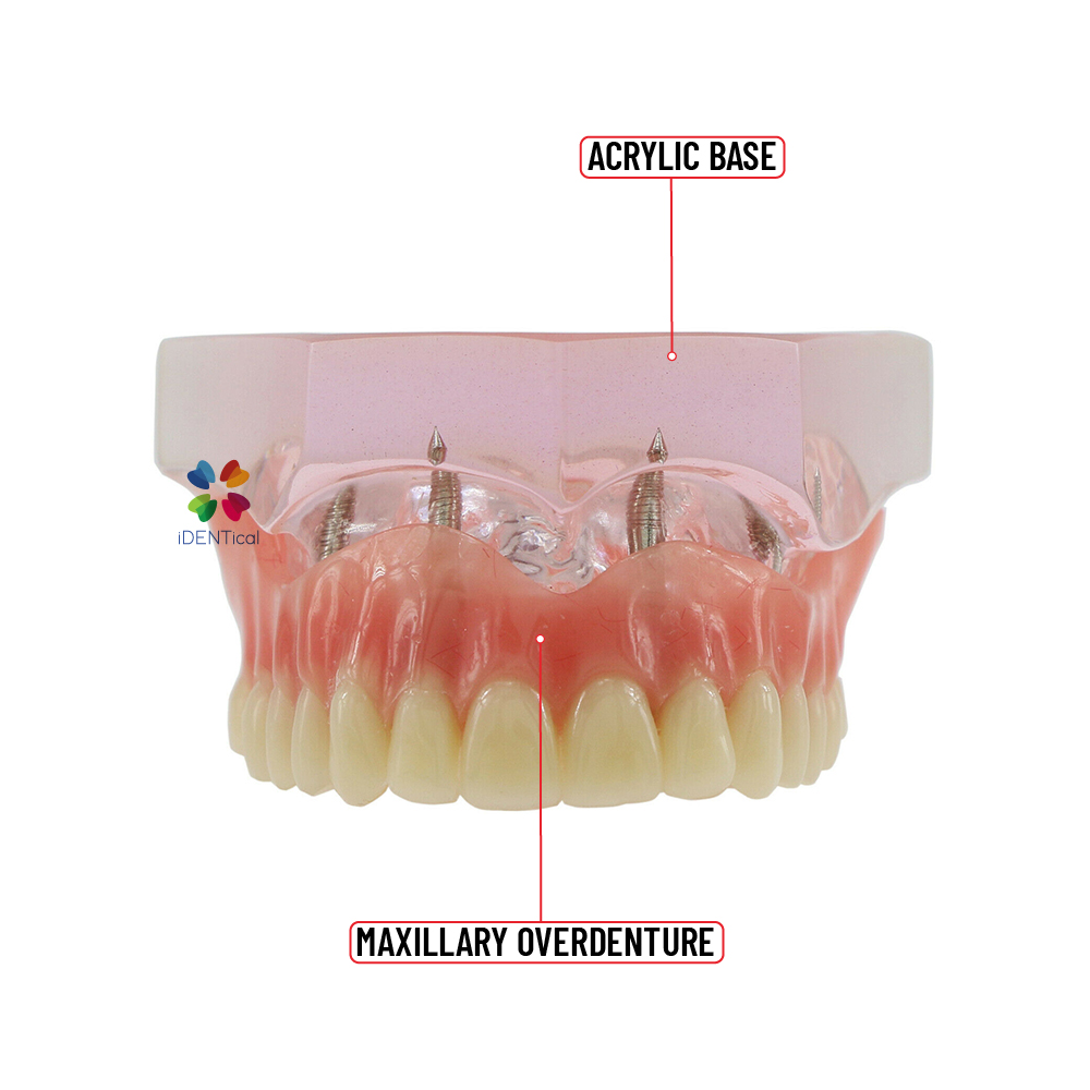 iDENTical Dental Model for Overdenture Maxilla M6001