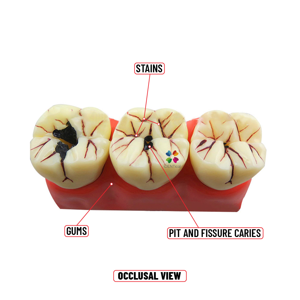 iDENTical Caries Development Tooth Model M4020