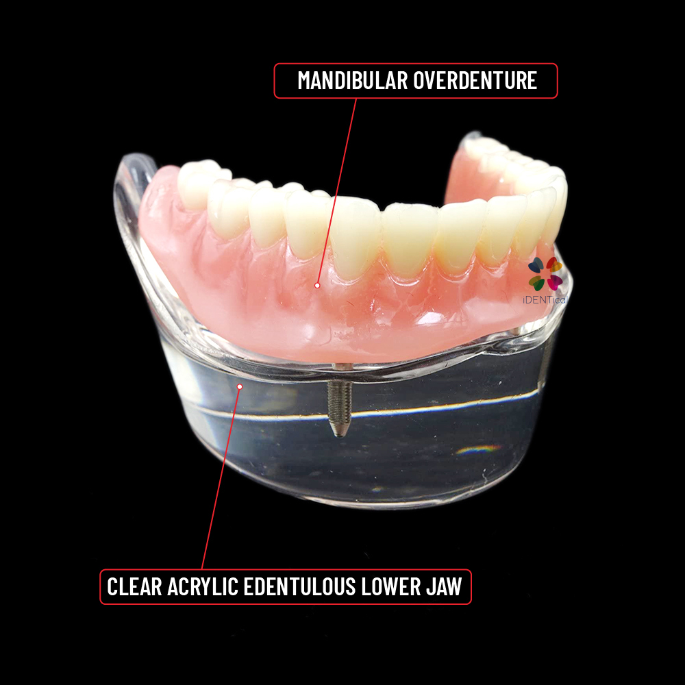 iDENTical Mandibular Overdenture Model with 2 Implants M6002