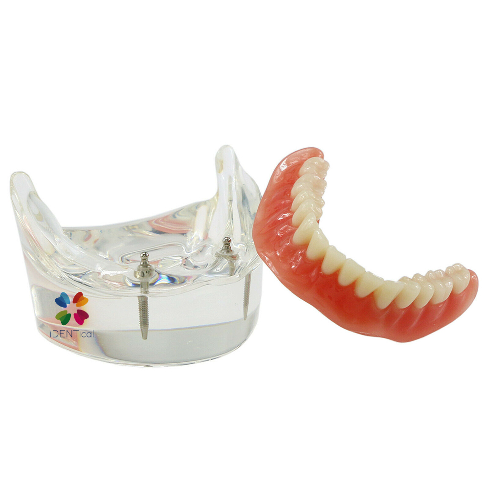 iDENTical Mandibular Overdenture Model with 2 Implants M6002