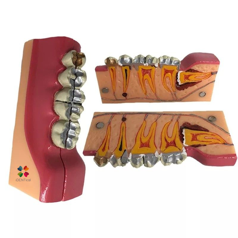 iDENTical Third molar Impaction Teeth Model M4009