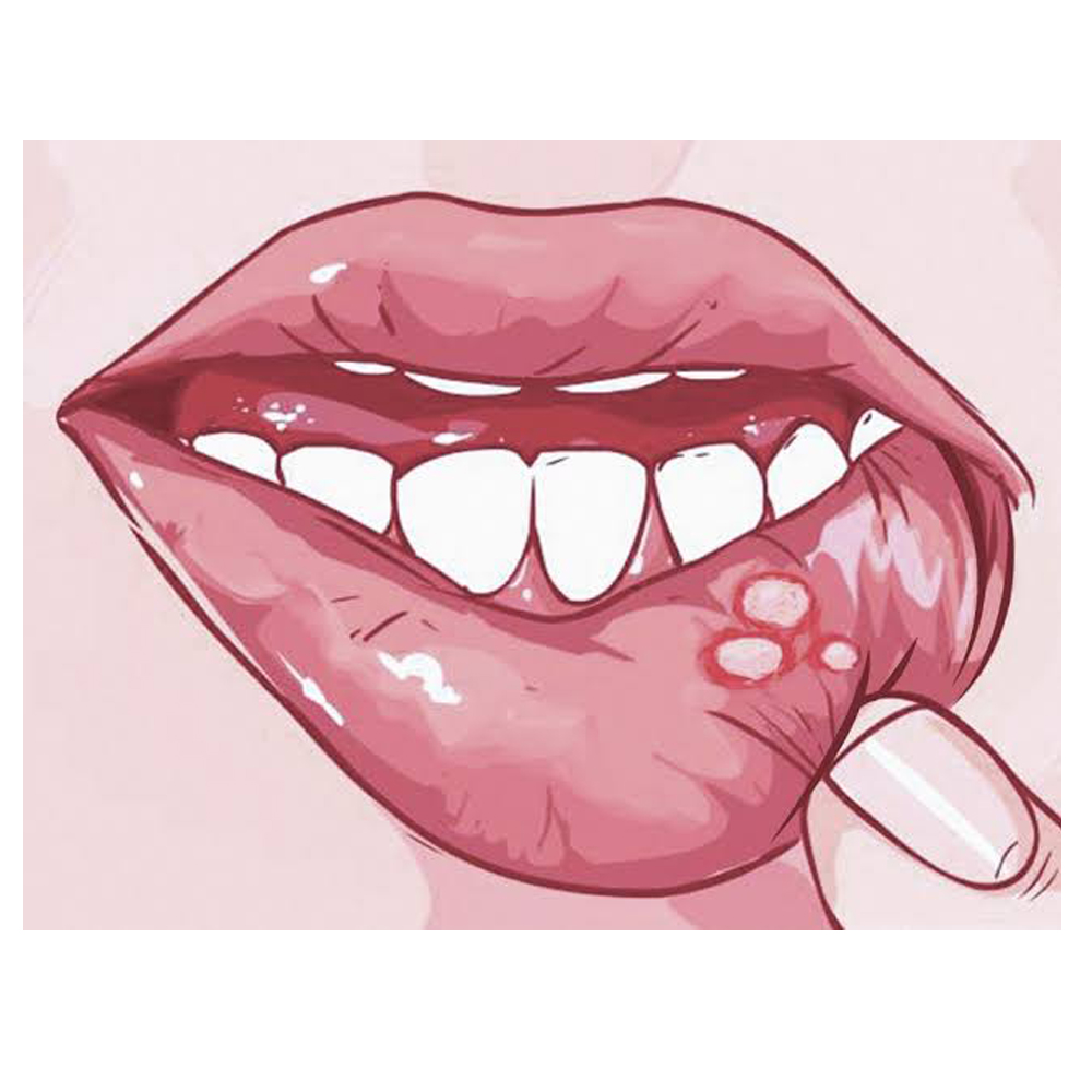 Dr.Morepen Ulcebye Mouth Ulcer Gel