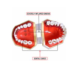 iDENTical Periodontal Disease Model M4025 - 5