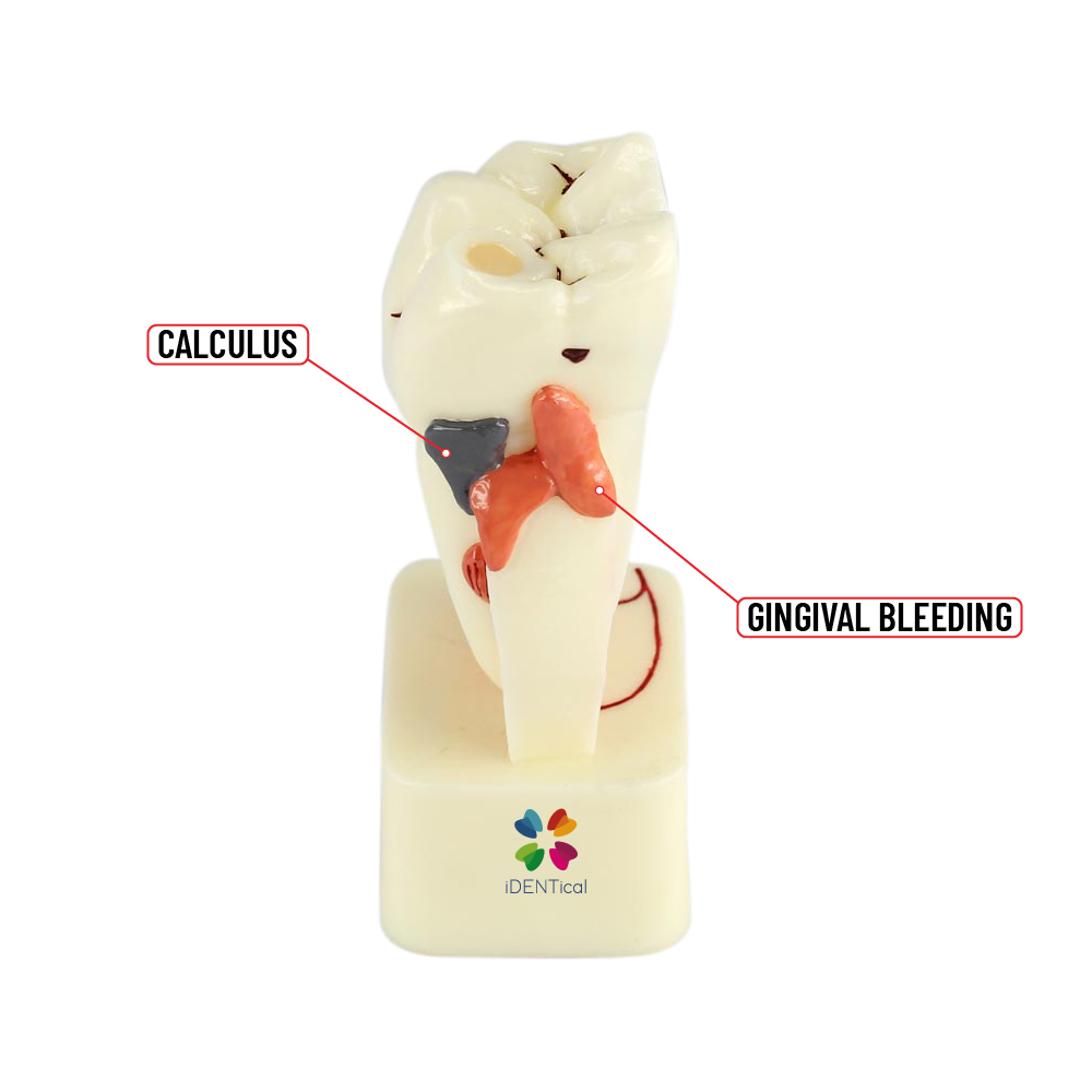 iDentical 4X Pathologies Of Tooth Model - M4015