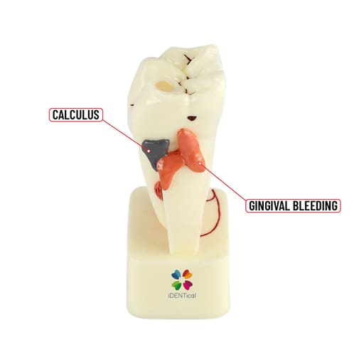 iDENTical 4X Pathologies Of Tooth Model - M4015