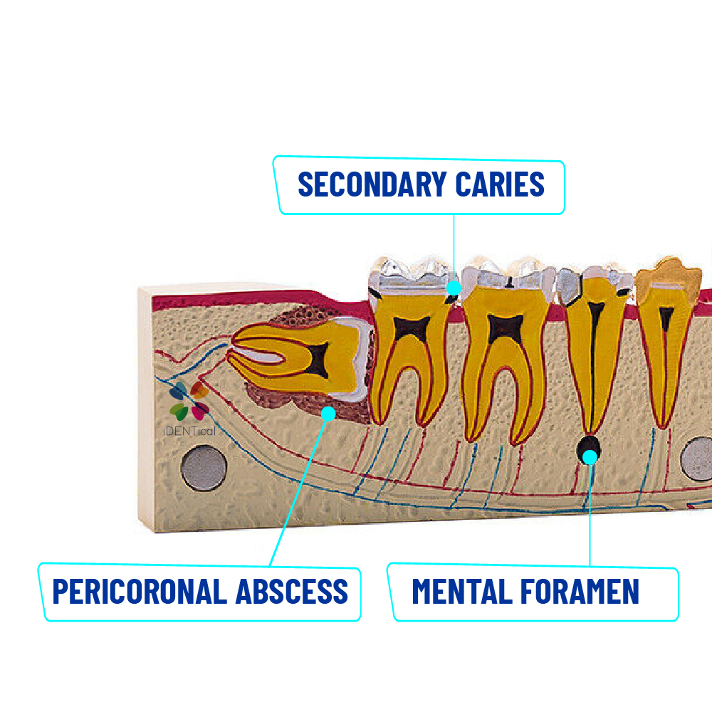 iDENTical Third molar Impaction Teeth Model M4009