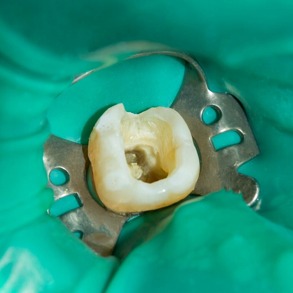 GDC Rubber Dam Clamp Adult 201 (Rdc201)