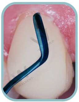 Waldent Plasma+ Composite Instrument Kit of 2 (K14/1) - 8