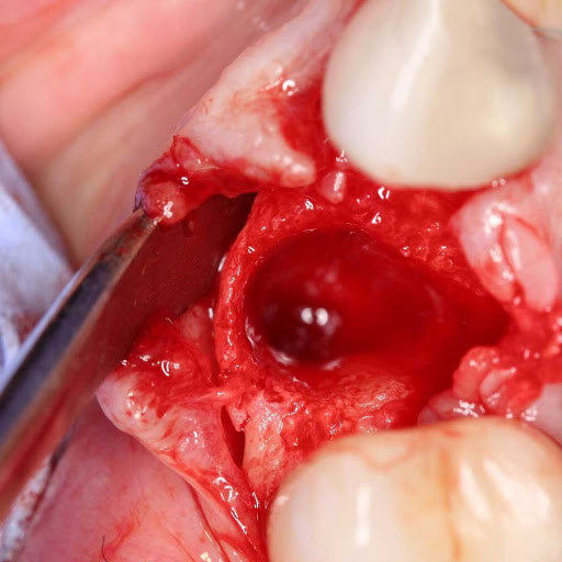 Waldent Periosteal Elevator Molt No.9 (9/108)