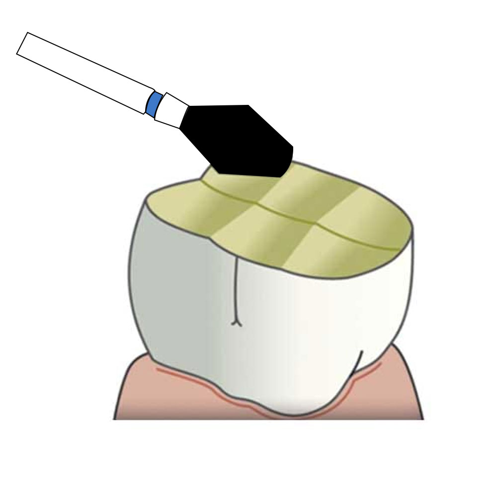 Frank Dental Barrel Diamond Bur EX (Made in Germany)