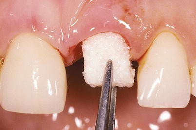 Goodwill Hemosponge 80x50x10 MM Absorbable Gelatin Sponge 2/pk - AGS851