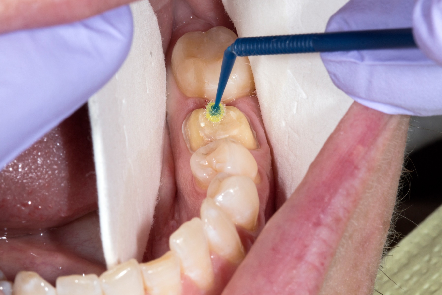 Waldent Silane Primer Syringe