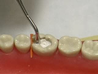 Medicept Stic Temporary Cavity Filling Material