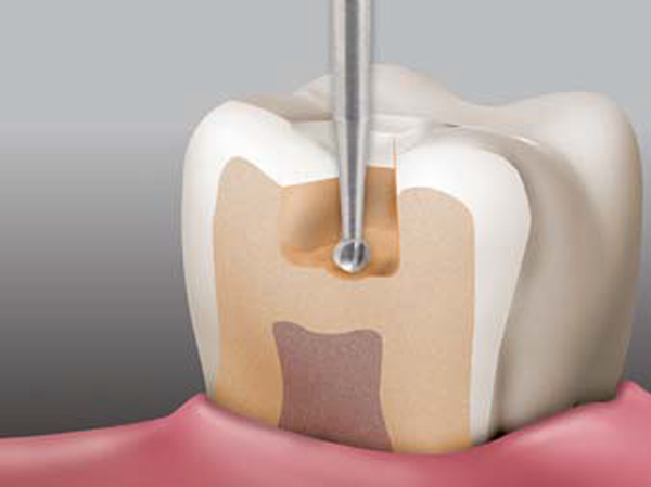 SS White Round Carbide Contra Angle Bur RA - 6 (310006) Pack Of 5