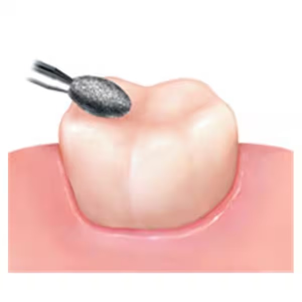 Frank Dental Flame Ogival FG Diamond Burs FO Series (Fine)