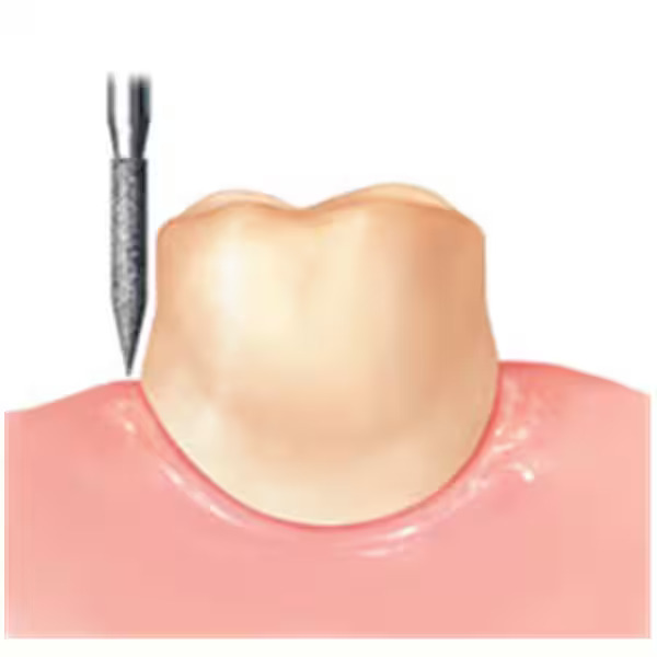 Frank Dental Tapered Ogival FG Diamond Burs TO- Series (Super Coarse)