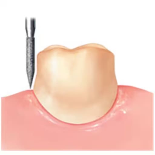 Frank Dental Tapered Ogival FG Diamond Burs TO- Series (Super Coarse)