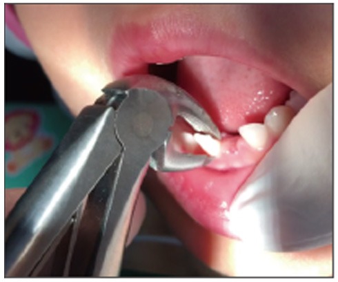 Waldent Pedo Extraction Forceps Kit Set of 7 (K1/2)