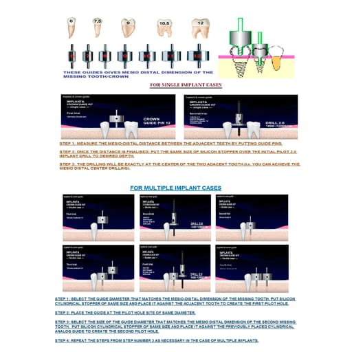 Julldent Mesio Distal Guidance System Kit (Jull-Dent 027)