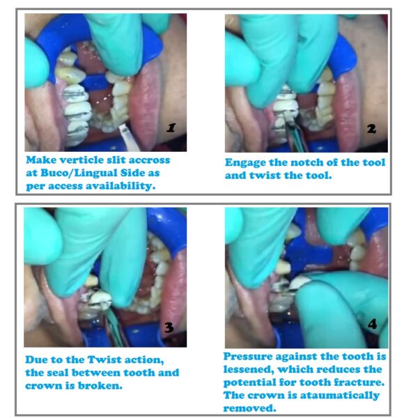 Julldent Crown Remover ( Christensen Design )