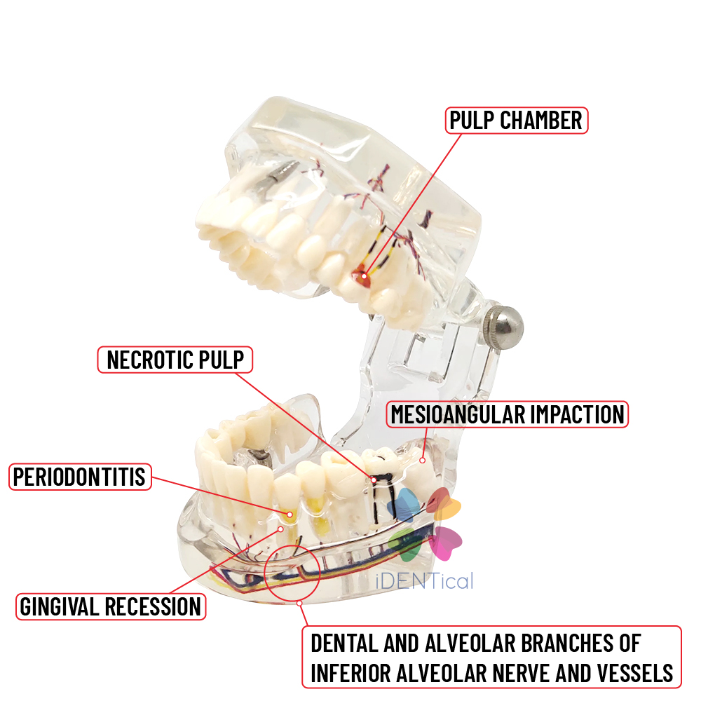 iDENTical Patient Education Model (Caries,implant,Nerves) M2001-3